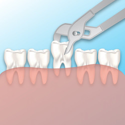 Tooth Extractions