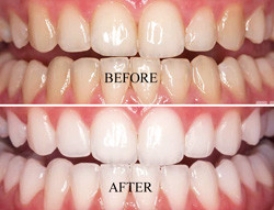 Tooth Polishing